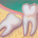 การผ่าฟันคุดหลังผ่าตัดไม่กี่วันก็หาย ไม่น่ากลัวและช่วยให้หน้าเรียวขึ้นได้จริงหรือไม่